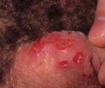 Features of the treatment of herpetic urethritis Can herpes cause urethritis