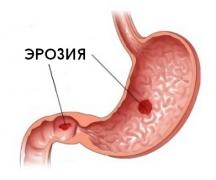 Erosion of the stomach - treatment with folk remedies Erosion of the antrum of the stomach - treatment with folk remedies